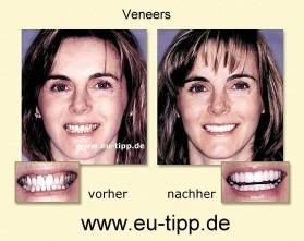 ZAHN-Reise CZ -günstiger als Ungarn- Implantate 490 Euro