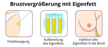 Sponsor für Brustvergrößerung mit Eigenfett gesucht